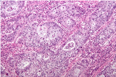 Figure 2: Adenosquamous carcinoma delineating glandular configurations layered by mucin secreting columnar epithelium incorporated with eosinophilic cytoplasm, apical mucin and basal, hyperchromatic nuclei admixed with foci of squamous cell carcinoma constituted of polygonal cells lacking intercellular bridges [7].