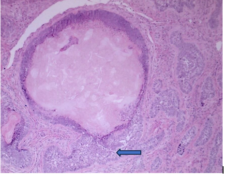 Figure 2: Basal cell carcinoma continuous with basaloid and ghost cells of pilomatrixoma (arrow) (x200 H&E).