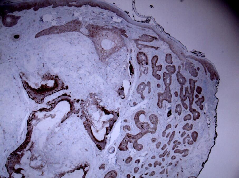 Figure 4: β-catenin positivity in BCC and pilomatrixoma component (x40).