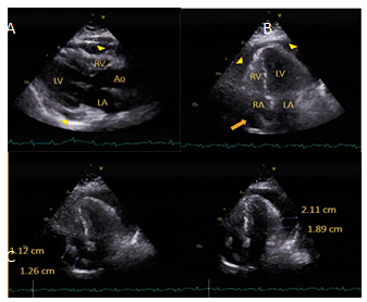 Figure 2: 2D Echocardiography. A. Parasternal long axis (PLAX) view showing pericardial effusion (arrowheads) with right ventricular diastolic collapse consistent with cardiac tamponade. B&C. Apical 4-Chamber (A4C) views showing circumferential pericardial effusion (arrowheads) with corresponding measurements, largest being 2.11 cm. There was note of right atrial systolic collapse consistent with cardiac tamponade (arrow).