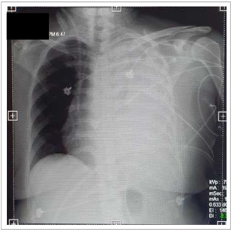 Figure 3: Chest Xray taken on the 4th hospital day showing complete opacification of the left hemithorax due to increased pleural effusion with associated mild contralateral shift of the mediastinal structures.