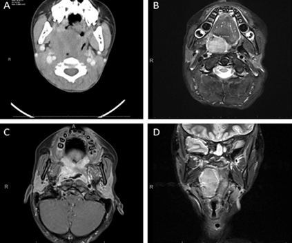 Figure 1: Before debulking, axial CT image of circumscribed mass within the right palatine tonsillar region (A). After debulking, magnetic resonance imaging (MRI) of the mass (B-D). Transverse T2-weighted image (B) and coronal T2-weighted image (C) show the size of the mass, Transverse T1-weighted image shows extension into the right parapharyngeal space, and into the right glossotonsillar sulcus without local infiltration (D).