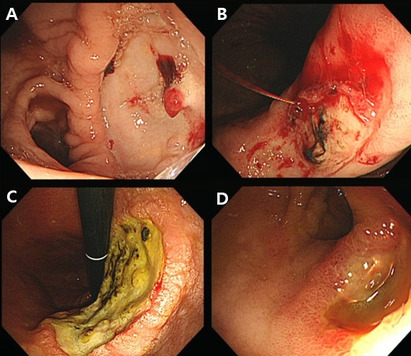 Figure 1: Endoscopic features with high risk of rebleeding. (A) Ulcer size larger than 1 cm. (B) Forrest 1a bleeding (Active arterial bleeding). (C) Ulcer at the lesser curvature of corpus. (D) Ulcer at posterior wall side of bulb.