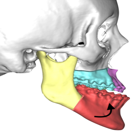 Figure 1: Virtual planning showing sagittal osteotomy setback, Le Fort I, and counterclockwise rotation.