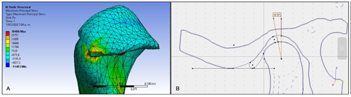 Figure 2: The posterior limit of the disc was located 10º degrees in front of the vertical axis of the center of rotation of the mandibular condyle and its volume was determined by the space between the condyle and mandibular fossa.