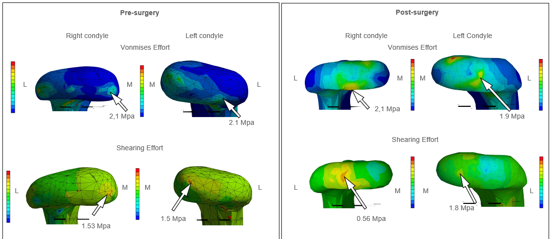 Figure 3: Comparison pre and post-surgical on right and left condyle.