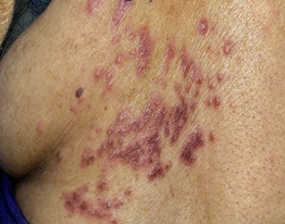 Figure 1: Common Site of Shingles: Base of the back of neck, around chest.