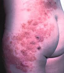 Figure 2: Shingles-Uncommon Site: Lower back, buttocks and back.