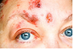 Figure 4: Herpes Zoster Ophthalmicus.