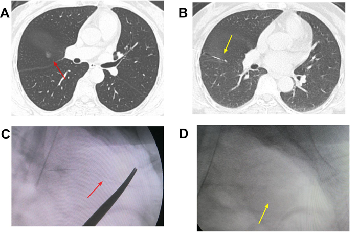 Figure 1: In case 1, A Red arrow points to a pulmonary nodule in the right upper lobe before surgery. B Yellow arrow points to a pulmonary nodule located by Hook wire before operation. C The red arrow points to the Intraoperative C-shaped X-ray localization of the Hook wire in the muscular layer of the chest wall. D The yellow arrow points to an X-ray picture of the right chest wall after removing the Hook wire.