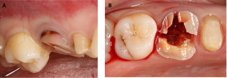 Figure 3: To carry out minimally traumatic extraction, #16 crown was firstly sectioned (A) and individual roots separated with a bur (B).