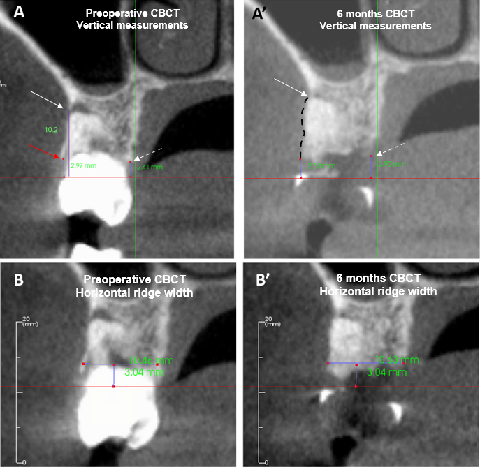 Figure 6: Preoperative CBCT (A, B) and at 6 months CBCT (A’, B’) were used for linear and horizontal measurements. The 6 months cross-sectional CBCT scan showed buccal augmentation (black dashed line) and infill to the apex of the buccal defect (A, arrowed). To anticipate the fracture of the coronal buccal plate during extraction (red arrow), the preoperative BRH was measured from the CEJ to the most apical part of the buccal defect (white arrow). Therefore, the preoperative BRH was 10.2mm, and this increased to 2.53mm at 6 months (A, A’). The LRH was measured from the CEJ to the alveolar crest (dashed arrow), which measured 2.41mm preoperative, and increased to 2.90mm postoperatively (A, A’). The preoperative HRW was 10.46mm and postoperatively, this increased to 10.63mm (B, B’).