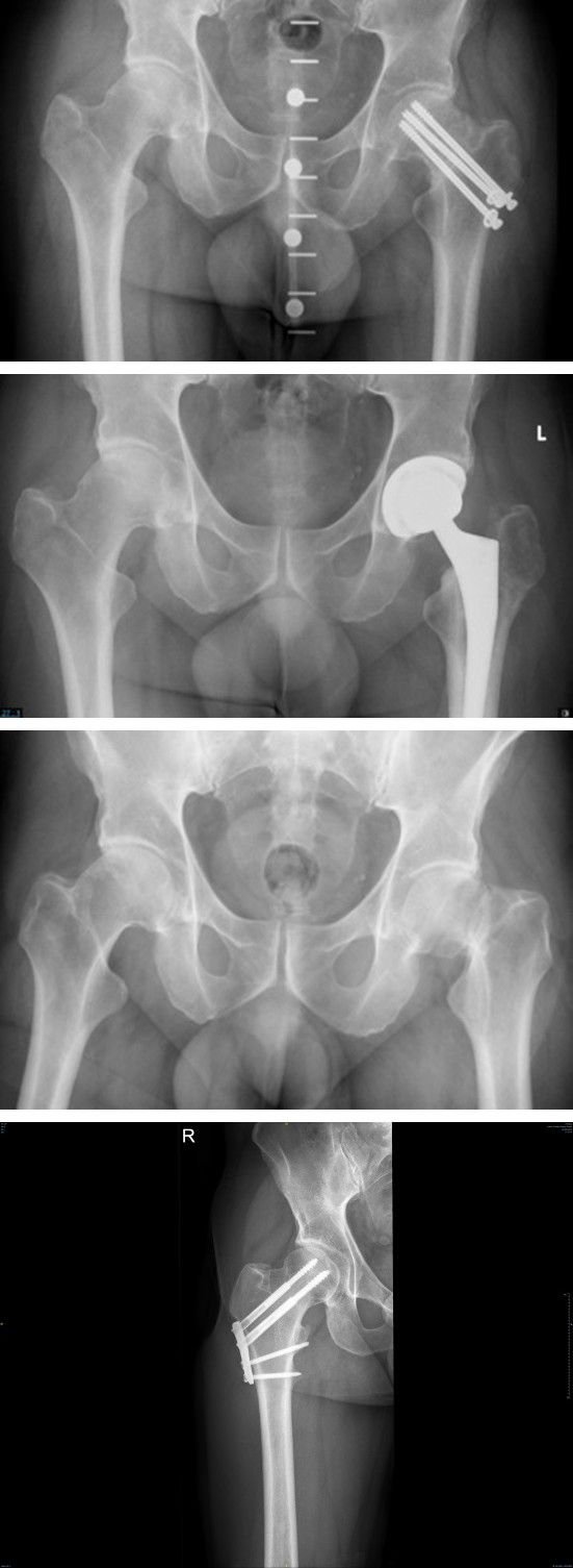 Figure 1: ** From Left to Right: anterior posterior X ray of a 53 y/o male with left femur Pauwels III fracture (A), who had closed reduction internal fixation using CCS, developed nonunion of the fracture(B) and underwent total hip arthroplasty 10 months later. CCS; cannulated cancellous screws.