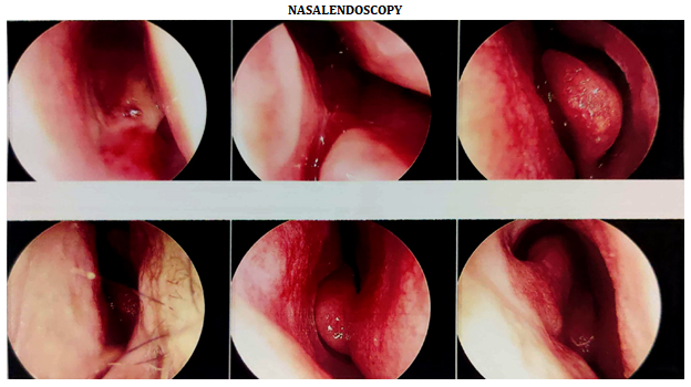 Figure 1: Endoscopic view of tumor.