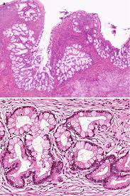 Figure 2: Lobular endocervical glandular hyperplasia delineating acinar architecture constituted of glandular configurations lined by tall, columnar, mucin secreting epithelium permeated with eosinophilic cytoplasm, basal nuclei and minimal atypia. Mitotic activity is minimal [9].