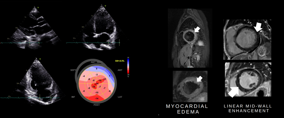 Figure 2: Cardiac MRI with Gadolinium Contrast: Findings suggestive of acute to subacute perimyocarditis. Myocardial edema involving the basal to mid inferior septum, basal to apical inferior, basal to mid inferolateral, basal to mid anterolateral, and apical lateral segments (left). Linear mid-wall enhancement involving the basal to apical septum, basal to apical inferior, basal to mid inferolateral, and apical lateral segments (right). Normal pericardial thickness with pericardial enhancement.