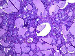 Figure 2: Tunnel clusters of uterine cervix delineating cystic dilatation of endocervical glands. Lining cuboidal to columnar epithelium is bland with apical, intracytoplasmic mucin and basal nuclei. Cytological and nuclear atypia is minimal to absent. Encompassing stroma is fibrotic [9].