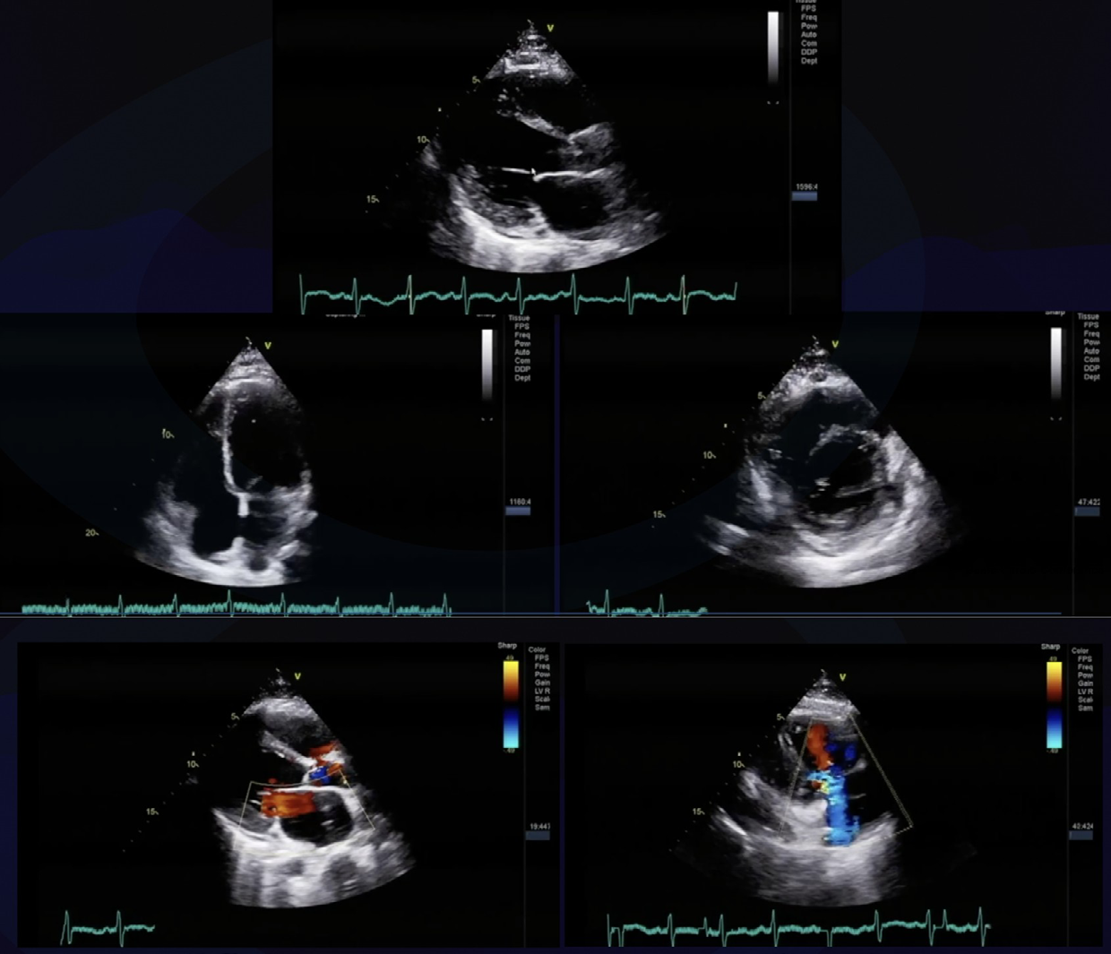 Figure 1: Transthoracic 2D Echocardiography of the patient taken on Parasternal Long Axis View, Apical 4-chamber view, Parasternal Short Axis View and Color Flow Studies showing MR and TR.