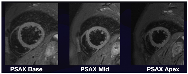 Figure 3: Short Axis Views of Edema Sequence of Cardiac MRI.