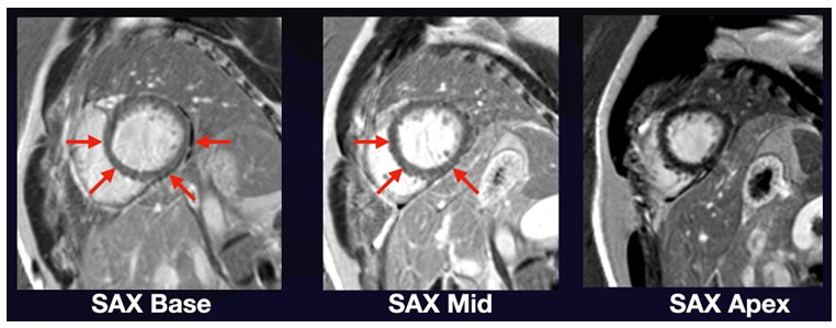 Figure 4: Short Axis Views of Post-Contrast Cardiac MRI showing Late Gadolinium Enhancement of the basal to mid anterior septum, basal to mid inferior septum, basal to mid inferolateral, and basal lateral segments In summary, the use of Multimodality Imaging - 2D echo and MRI is recommended on initial evaluation of cardiomyopathy with 2D echo superior due to its cost benefit ratio in monitoring the progression of the disease and response to therapy, provided that we get good quality images enough to infer the necessary information. And if CAD is highly considered or significantly contributing to the clinical condition then CT coronary angiography or stress imaging may be considered.