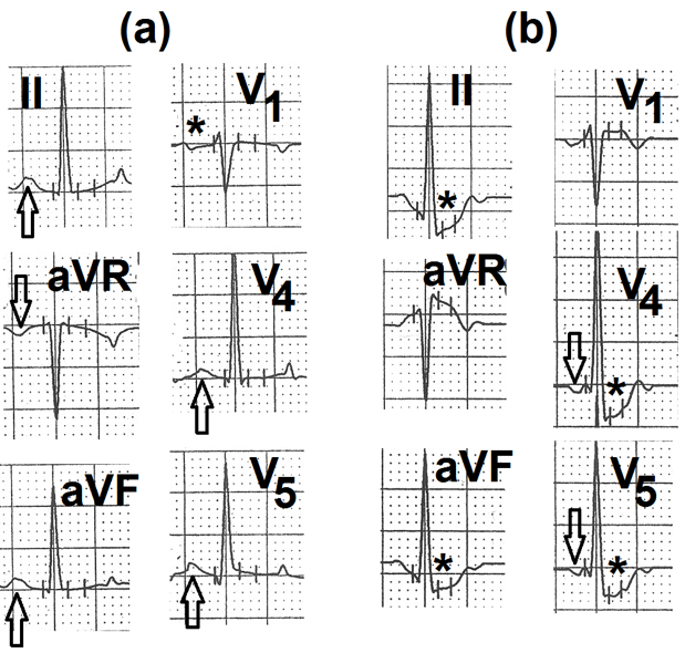 Figure 3: a: Resting supine electrocardiogram showing positive P waves in leads II, aVF, V4 and V5 (marked as ↑). P wave is inverted in lead aVR (marked as ↓) and biphasic (+/-) in lead V1 (marked as ∗) Findings are suggestive of normal sinus rhythm. b: Electrocardiogram recorded at peak exercise. P waves are inverted in leads V4 and V5 (marked as ↓). The PR interval is short. Findings are suggestive of junctional rhythm. There is slow upsloping ST-segment depression in leads II, aVF, V5 and V6 (marked as ∗).