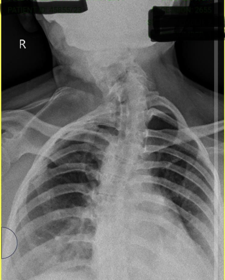 Figure 2: X-ray Neck AP view.