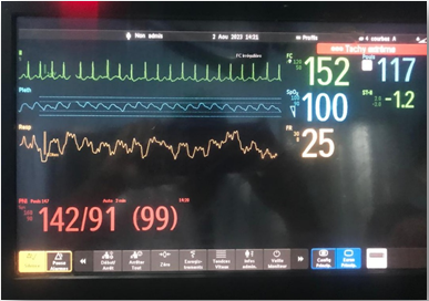 Figure 1: Intraoperative electrocardioscop monitor showing a HR that reached 155 BPM without “p” waves indicating AF.