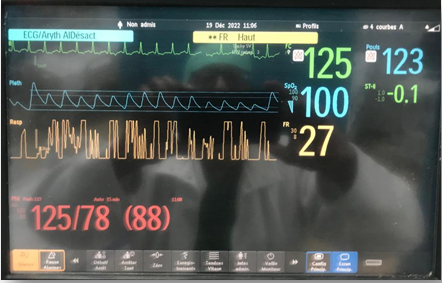 Figure 3: Arriving In the operating room, the patient presented with tachycardia with a heart rate of 125 on the monitor.