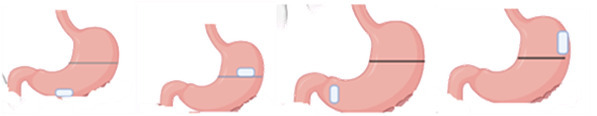 Figure 1: Depiction of varieties of drug delivery systems designed for prolonged retention in the GI tract a) Floating system b) High density system c) Inflatable system d) Mucoadhesive system.