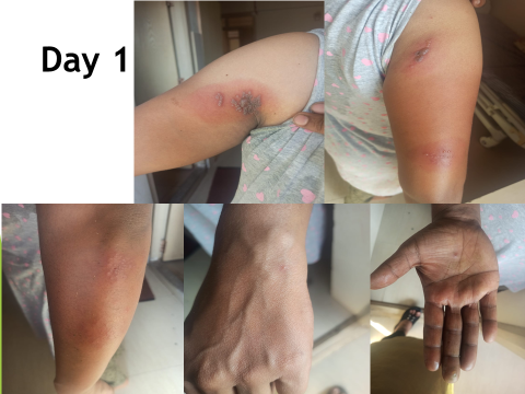 Figure 1: Treatment Day 1.