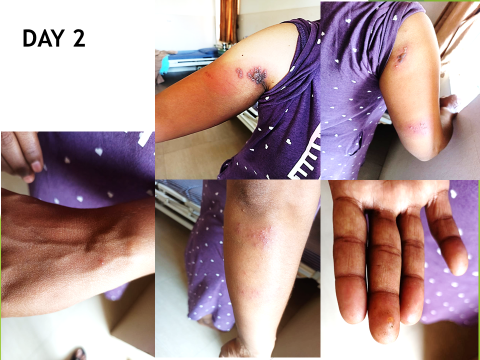 Figure 2: Treatment Day 2.