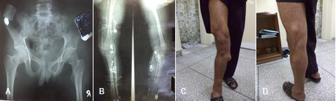 Figure 1: c, d). Pain and swelling increase with standing and walking. Cutaneous pigmentation was obvious throughout the limb. The patient visited surgeon and he advised him to undergo the Doppler ultrasound of right leg. On the basis of the results, vascular abnormality was noted and varicose veins were ruled out. Spider like hemangioma was found on clinical examination.All the baseline investigations of the patient including Complete Blood Count (CBC), Differential Leukocyte Count (DLC), Liver Function Tests (LFTs) and Renal Function Tests (RFTs) were normal. X ray of pelvis and both femora showed that hip bone and right femur of involved side are larger than the contralateral side (Figure1: A). This discrepancy is also evident on angiography which showed hypertrophied and slightly large right femur when compared to left femur (Figure 1 B).