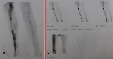 Figure 3: (A and B) showing Scintivenography of superficial and deep veins of leg.