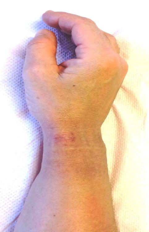 Figure 1: Scar after Surgery. Complications that limit normal hand function still occur despite advances in surgical techniques and therapy protocols. We must be careful not to injure cutaneous branches of radial nerve (Figure 2), otherwise a painful neuroma can appear. It’s very frequent a transient lesion of the radial nerve (50-60% of cases). Deficit of the superficial radial nerve (Figure 3). Persistent numbness in the web of the thumb, again owing to injury of the radial nerve branches. Subluxation of the tendon or incomplete release and persistence of symptoms are also possible [20-22].