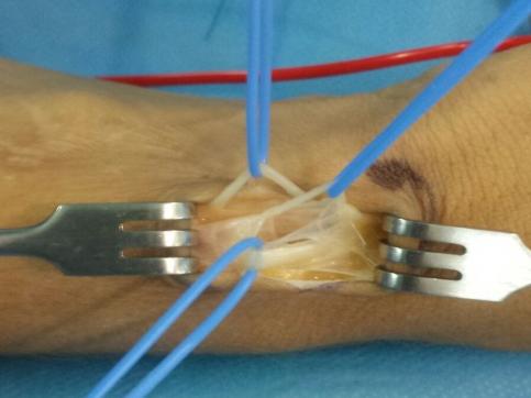 Figure 2: Sensitive Cutaneous Branches of Radial Nerve.