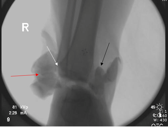 Figure 1: Anteroposterior radiograph demonstrating a right extruded talus with talar neck fracture (red arrow) and associated medial (black arrow) and lateral malleolar fractures (white arrow).