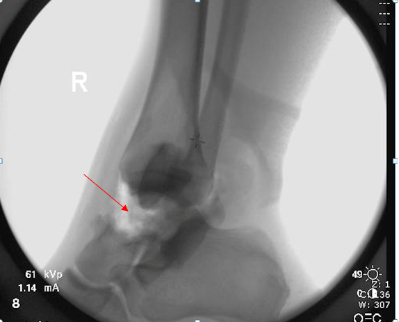 Figure 2: Lateral radiograph demonstrating a right extruded talus with talar neck fracture (red arrow).