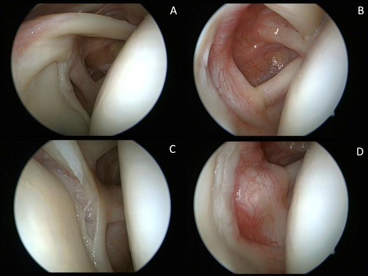 Figure 2: Biceps tendon (A) and SLAP lesion (D) in dry technique, visible capillary circulation and hyperemic areas in the joint (B,C) Our recommendation is to avoid too close to the scope tip when examining the tissues to avoid splashes. If there is a minor splash onto the scope’s tip it can be removed by gently rubbing the tip on the local soft tissue. This will clear the view sufficently.