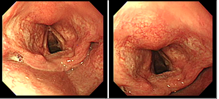 Figure 3: Paten airway after one month. Figures 3a & 3b: One Months Later From Polypectomy. Olympus CV 260.