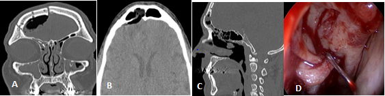 Figure 5: Postoperative Pneumocephalus Following a Craniotomy and Defective Frontal Sinus Obliteration. A, B, C: Computed Tomography Showing Discontinuity of the Posterior Wall of the Frontal Sinus and Neumocephalus; D: Draf II-A and Obliteration of the Frontal Sinus Ostium with a Bipedicle Middle Turbinate Mucoperiosteal Flap with Lateral Rotation.
