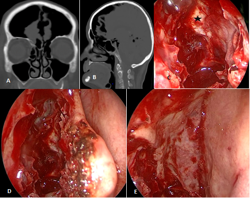 Figure 6: A: Left Ethmoid Fovea Defect Due to Cranial Trauma (Arrow); B: Computed Tomography; C: Exposed Meninges (Asterisk); D: Resection of the Lateral Half of the Middle Turbinate and Turbinate Bone; E: Medial Rotation of the Middle Turbinate’s Mucoperiosteum to Repair the Defect.