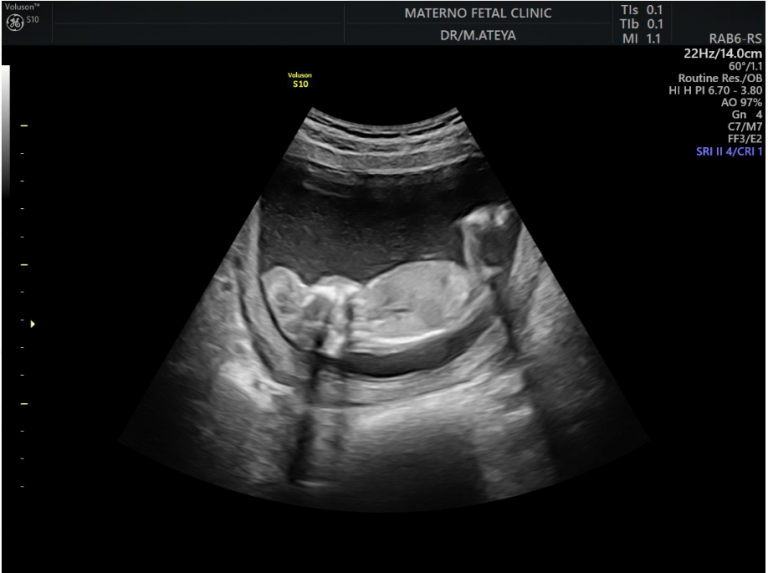 Figure 10: Two-dimensional ultrasound showing exencephaly of the studied patient.