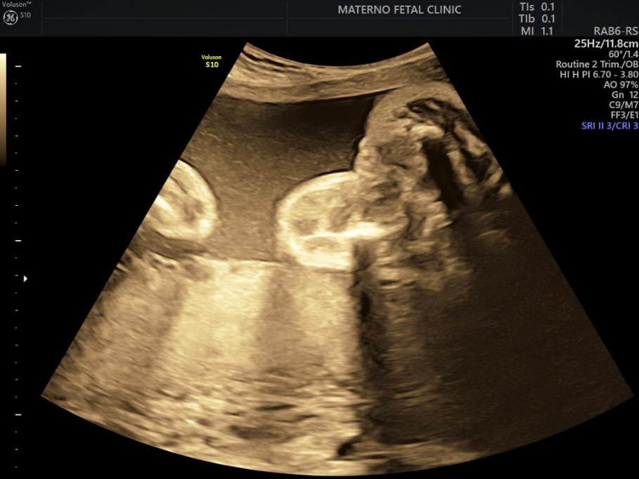 Figure 6: Two-dimensional ultrasound showing acrania of the studied patients.