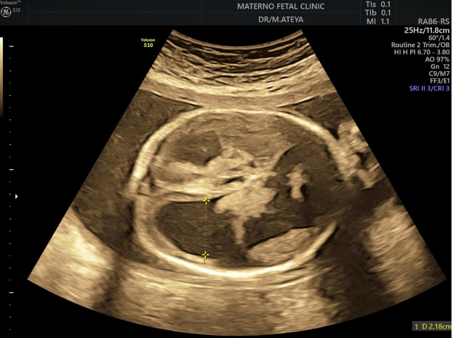 Figure 7: Two-dimensional ultrasound showing Intracranial hemorrhage of the studied patients.