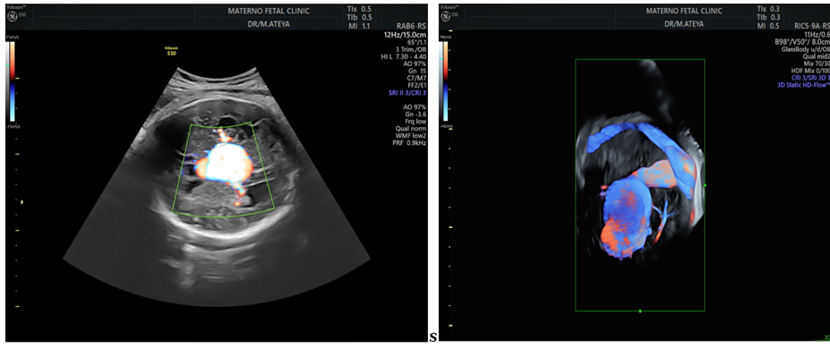 Figure 9: Two-dimensional ultrasound showing aneurysm of the studied patients.