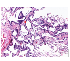 Figure 1: Atypical adenomatous hyperplasia demonstrating alveolar spaces lined by columnar epithelial cells incorporated with eosinophilic cytoplasm, enlarged, hyperchromatic nuclei with enhanced nucleocytoplasmic ratio and mild cellular and nuclear atypia. Surrounding pulmonary parenchyma appears unremarkable [6].