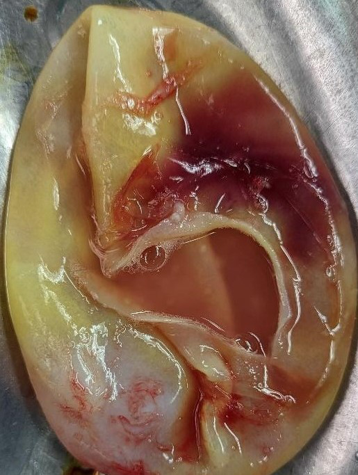 Figure 3: Photo of Removed Cyst.
