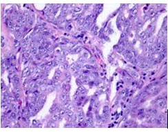 Figure 1: SMARCB1 deficient medullary renal cell carcinoma delineating sheets and papillae of pleomorphic cells imbued with eosinophilic cytoplasm, enlarged hyperchromatic nuclei with vesicular chromatin and prominent nucleoli [5].