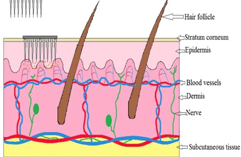 Figure 4: Humans can receive skin-impermeant drug transdermally thanks to microneedles. Numerous uses for microneedles are being investigated, such as immunological treatments, diabetes, and anticancer drugs [28].