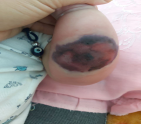 Figure 1: The ecchymotic lesion at the third day of its appearance.